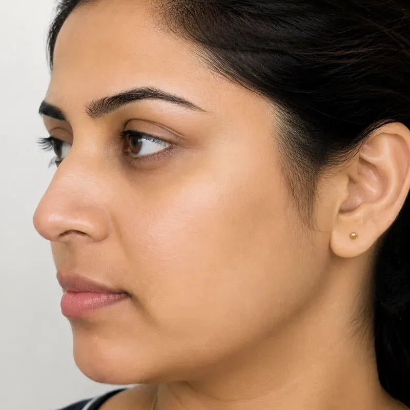 Illustrative Acne appearance example, second image